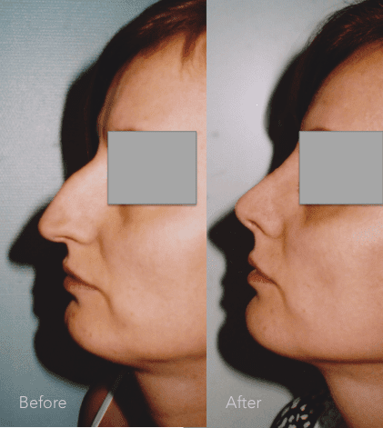 Chirurgia plastyczna twarzy – operacja nosa