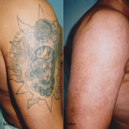 usuwanie tatuażów