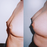 powiększanie piersi implantami