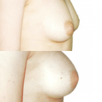 implanty piersi dr Checinski