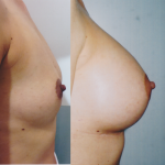 Powiększanie piersi implantami warszawa